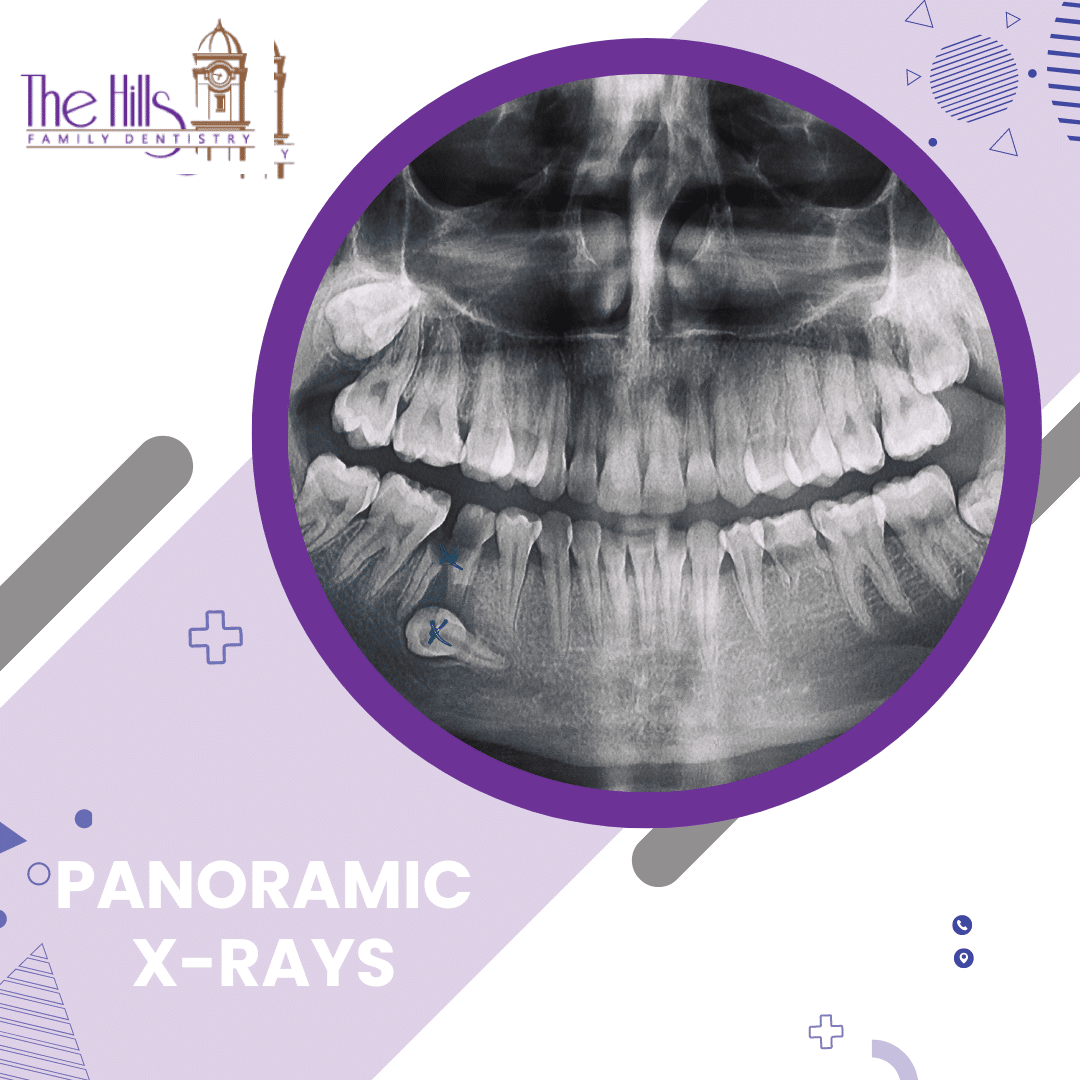 CBCT and Panoramic X-rays in San Marcos - The Hills Family Dentistry