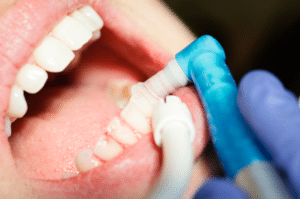Dental Cleaning in San Marcos - The Hills Family Dentistry