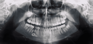 Panoramic X-rays in San Elijo Hills - The Hills Family Dentistry