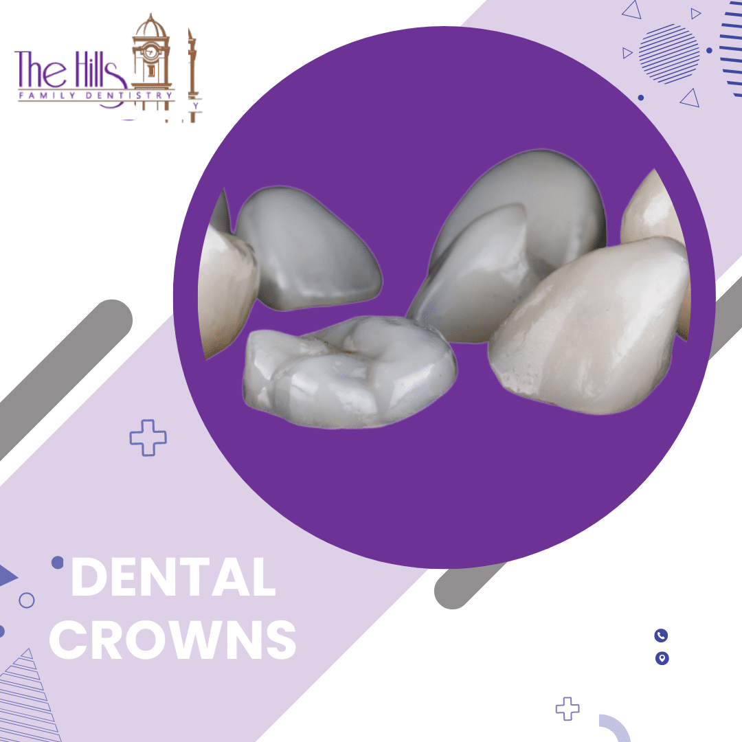In-office Cerec Crown in San Marcos - The Hills Family Dentistry