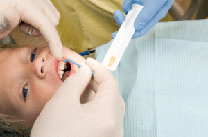 Fluoride Varnish and Cavity Reversal in San Marcos - The Hills Family Dentistry
