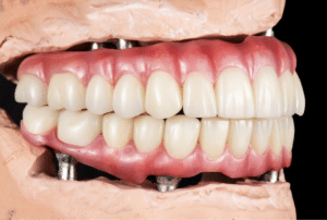 Hybrid Dentures in San Marcos - The Hills Family Dentistry