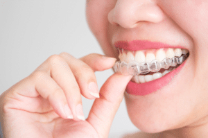 Invisalign Treatment in San Marcos - The Hills Family Dentistry