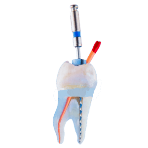 Root Canal in San Marcos - The Hills Family Dentistry