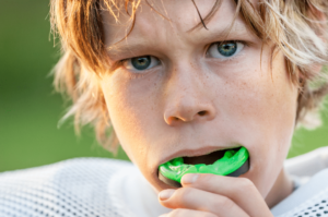 Sportsguard - Mouthguard for Sports - San Marcos Dentist
