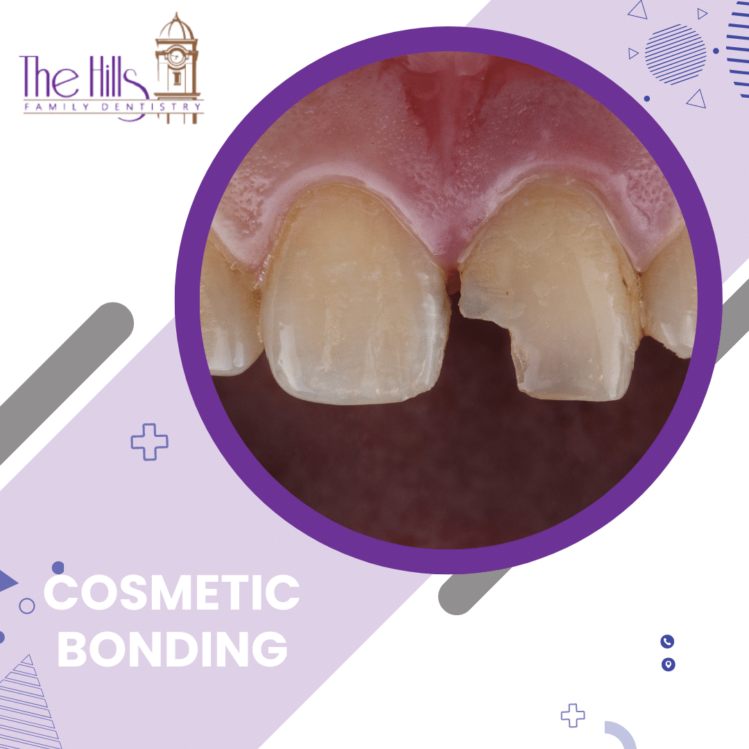 Cosmetic Bonding and Chairside Veneers - The Hills Family Dentistry - San Marcos Dentist
