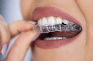 Clear Aligners in San Marcos - Dr. Thomas Invisalign Certified