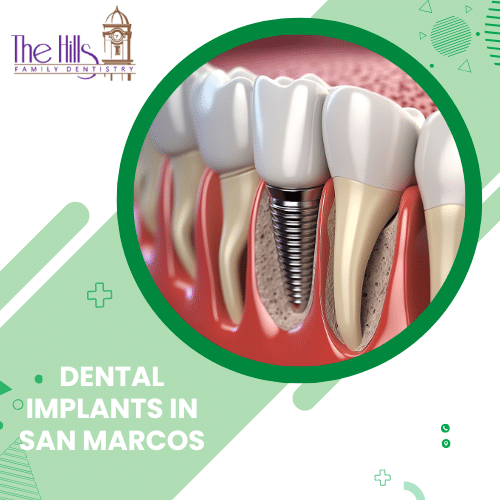 Dental Implants in San Marcos - The Hills Family Dentistry